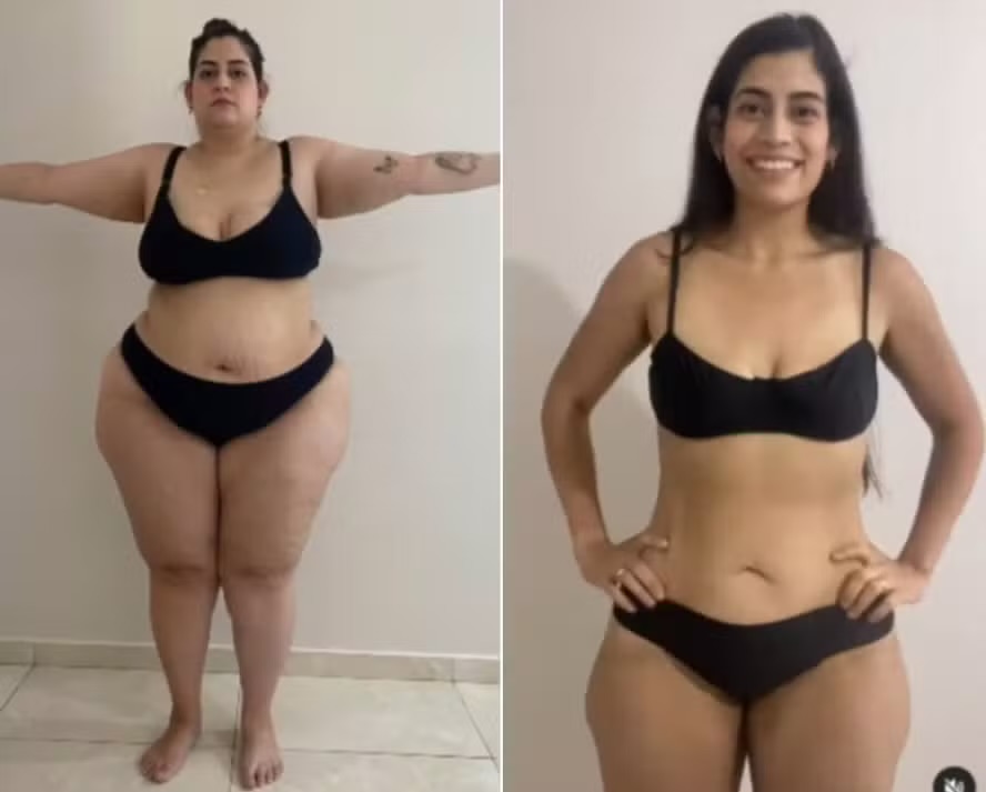 Antes e depois de paciente 1